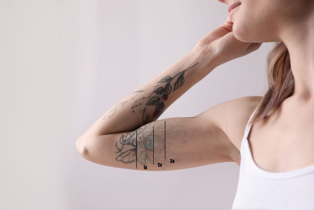Frau lässt Tattoo entfernen